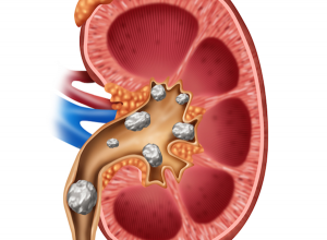 Điều trị sỏi thận cho trẻ thế nào?